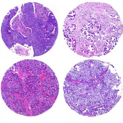Control Slides, Tissue Microarray, 16 Breast Tumors, Boxes of 10/25